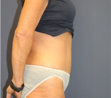 Tummy Tuck After Photo by Laurence Glickman, MD, MSc, FRCS(c),  FACS; Garden City, NY - Case 44802