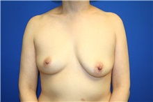 Breast Augmentation Before Photo by Laurence Glickman, MD, MSc, FRCS(c),  FACS; Garden City, NY - Case 44803