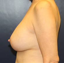 Breast Augmentation After Photo by Laurence Glickman, MD, MSc, FRCS(c),  FACS; Garden City, NY - Case 44803
