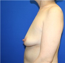 Breast Augmentation Before Photo by Laurence Glickman, MD, MSc, FRCS(c),  FACS; Garden City, NY - Case 44803