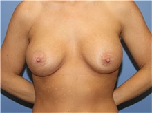 Breast Augmentation After Photo by Heather Furnas, MD, FACS; Santa Rosa, CA - Case 36651