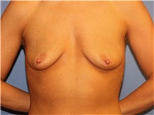 Breast Augmentation Before Photo by Heather Furnas, MD, FACS; Santa Rosa, CA - Case 36651