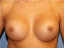 Breast Augmentation After Photo by Heather Furnas, MD, FACS; Santa Rosa, CA - Case 36652