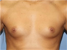 Breast Augmentation Before Photo by Heather Furnas, MD, FACS; Santa Rosa, CA - Case 36652