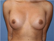 Breast Augmentation After Photo by Heather Furnas, MD, FACS; Santa Rosa, CA - Case 36653