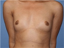 Breast Augmentation Before Photo by Heather Furnas, MD, FACS; Santa Rosa, CA - Case 36653