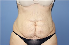 Tummy Tuck Before Photo by Francisco Canales, MD; Santa Rosa, CA - Case 31697