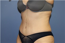 Tummy Tuck After Photo by Francisco Canales, MD; Santa Rosa, CA - Case 31697