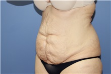 Tummy Tuck Before Photo by Francisco Canales, MD; Santa Rosa, CA - Case 31697