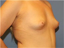 Breast Augmentation Before Photo by Francisco Canales, MD; Santa Rosa, CA - Case 41142