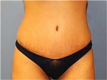 Tummy Tuck After Photo by Francisco Canales, MD; Santa Rosa, CA - Case 41143