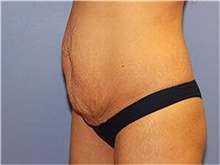 Tummy Tuck Before Photo by Francisco Canales, MD; Santa Rosa, CA - Case 41143