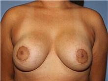Breast Augmentation After Photo by Francisco Canales, MD; Santa Rosa, CA - Case 41144