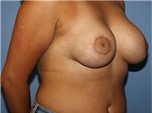 Breast Augmentation After Photo by Francisco Canales, MD; Santa Rosa, CA - Case 41144