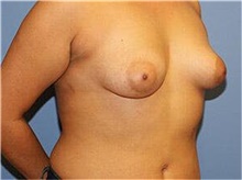 Breast Augmentation Before Photo by Francisco Canales, MD; Santa Rosa, CA - Case 41144