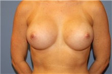Breast Augmentation After Photo by Francisco Canales, MD; Santa Rosa, CA - Case 41183