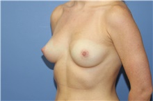 Breast Augmentation Before Photo by Francisco Canales, MD; Santa Rosa, CA - Case 41183