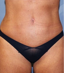 Tummy Tuck After Photo by Francisco Canales, MD; Santa Rosa, CA - Case 41184