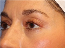 Eyelid Surgery After Photo by Francisco Canales, MD; Santa Rosa, CA - Case 41185