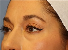 Eyelid Surgery Before Photo by Francisco Canales, MD; Santa Rosa, CA - Case 41185