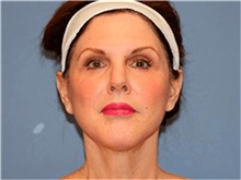 Facelift After Photo by Francisco Canales, MD; Santa Rosa, CA - Case 41186