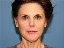 Facelift Before Photo by Francisco Canales, MD; Santa Rosa, CA - Case 41186