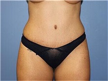 Tummy Tuck After Photo by Francisco Canales, MD; Santa Rosa, CA - Case 41189