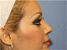 Rhinoplasty After Photo by Francisco Canales, MD; Santa Rosa, CA - Case 41192
