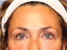 Eyelid Surgery After Photo by Francisco Canales, MD; Santa Rosa, CA - Case 41193