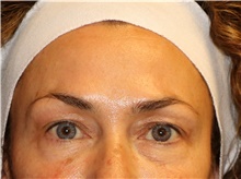 Eyelid Surgery Before Photo by Francisco Canales, MD; Santa Rosa, CA - Case 41193