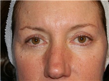 Eyelid Surgery After Photo by Francisco Canales, MD; Santa Rosa, CA - Case 41194