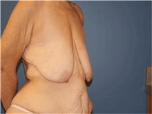 Breast Lift Before Photo by Francisco Canales, MD; Santa Rosa, CA - Case 41195