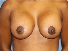 Breast Lift After Photo by Francisco Canales, MD; Santa Rosa, CA - Case 41196