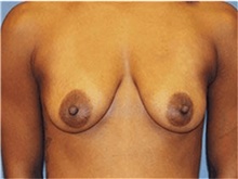 Breast Lift Before Photo by Francisco Canales, MD; Santa Rosa, CA - Case 41196