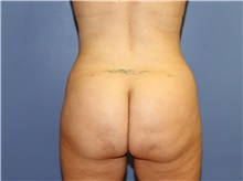 Buttock Lift with Augmentation After Photo by Francisco Canales, MD; Santa Rosa, CA - Case 41199