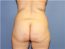 Buttock Lift with Augmentation Before Photo by Francisco Canales, MD; Santa Rosa, CA - Case 41199