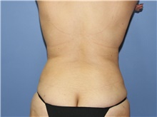 Liposuction After Photo by Francisco Canales, MD; Santa Rosa, CA - Case 41200