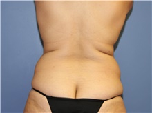 Liposuction Before Photo by Francisco Canales, MD; Santa Rosa, CA - Case 41200