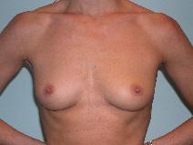 Breast Augmentation Before Photo by James Sheridan, MD; Austin, TX - Case 6977