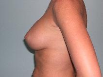 Breast Augmentation After Photo by James Sheridan, MD; Austin, TX - Case 6977