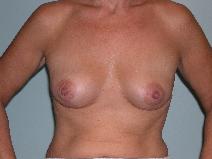 Breast Reduction After Photo by James Sheridan, MD; Austin, TX - Case 6987