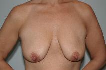 Breast Reduction Before Photo by James Sheridan, MD; Austin, TX - Case 6987