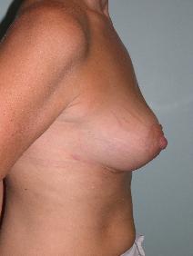 Breast Reduction After Photo by James Sheridan, MD; Austin, TX - Case 6987