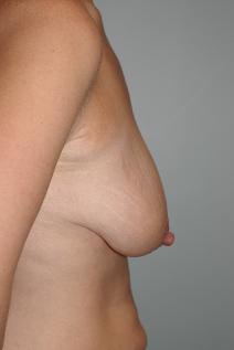 Breast Reduction Before Photo by James Sheridan, MD; Austin, TX - Case 6987