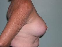 Breast Augmentation After Photo by James Sheridan, MD; Austin, TX - Case 6989