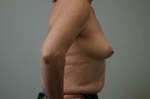 Breast Augmentation Before Photo by James Sheridan, MD; Austin, TX - Case 6989
