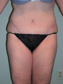 Tummy Tuck After Photo by James Sheridan, MD; Austin, TX - Case 6990