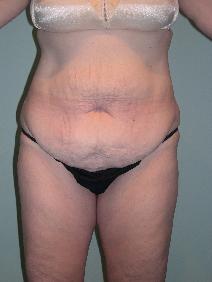 Tummy Tuck Before Photo by James Sheridan, MD; Austin, TX - Case 6990