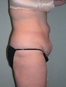 Tummy Tuck Before Photo by James Sheridan, MD; Austin, TX - Case 6990