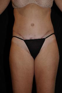 Tummy Tuck After Photo by James Sheridan, MD; Austin, TX - Case 7506